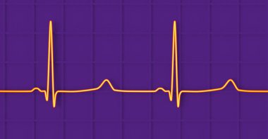 Tip 3 uzun QT sendromunun EKG 'si. Uzun bir izoelektrik segmentten önce son zamanlardaki T dalgalarını gösteren 3D illüstrasyon..