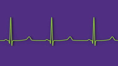 ECG of type 3 long QT syndrome, 3D illustration showing late onset T waves being preceded by a long isoelectric segment. clipart