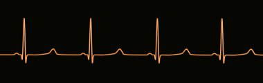 ECG of type 3 long QT syndrome, 3D illustration showing late onset T waves being preceded by a long isoelectric segment. clipart