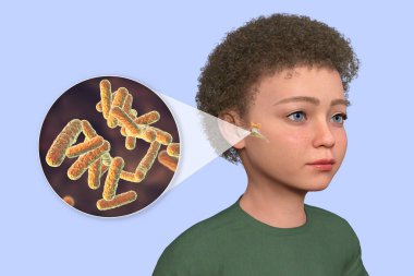 3D illustration of a child with transparent skin revealing otitis media and a close-up view of bacteria that caused it. clipart