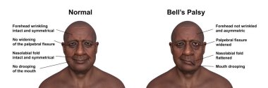 Bir erkekte yüz felci ve yüzünün bir tarafındaki asimetri ve düşüşün altını çizen aynı sağlıklı insan, fotorealistik üç boyutlu çizim..