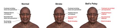 Sol (ortada), yüz felci (solda) ve aynı sağlıklı (sağda), üç boyutlu bir illüstrasyon gösteren bir erkek.
