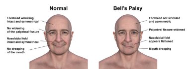 Bir erkekte yüz felci ve yüzünün bir tarafındaki asimetri ve düşüşün altını çizen aynı sağlıklı insan, fotorealistik üç boyutlu çizim..