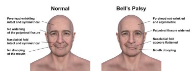 Facial palsy in a man, and the same healthy person, photorealistic 3D illustration highlighting the asymmetry and drooping of the facial muscles on one side of the face. clipart