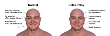Bir erkekte yüz felci ve yüzünün bir tarafındaki asimetri ve düşüşün altını çizen aynı sağlıklı insan, fotorealistik üç boyutlu çizim..
