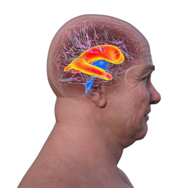 A 3D scientific illustration depicting enlarged lateral ventricles of the brain (hydrocephalus), side view. clipart