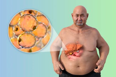 Beyaz tenli, yağlı bir karaciğeri ortaya çıkaran, karaciğer anatomisini ve yağ birikimini ön plana çıkaran beyaz bir adamın üç boyutlu resmi..