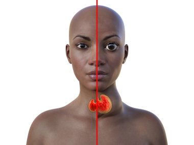 3D illustration of a young African womans face and neck with transparent skin, displaying a normal thyroid gland and enlarged thyroid with exophthalmos. clipart