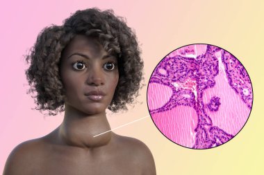 3D illustration of an African woman with enlarged thyroid and exophthalmos alongside with light micrograph of toxic goiter. clipart