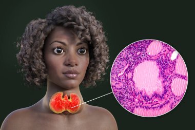 3D illustration of an African woman with enlarged thyroid and exophthalmos alongside with light micrograph of toxic goiter. clipart