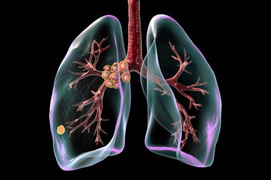 Ranke kompleksiyle birincil akciğer tüberkülozu, pulmoner lezyonları ve mediastal lenf iltihabını vurgulayan üç boyutlu illüstrasyon.