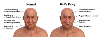 Bir erkekte yüz felci ve yüzünün bir tarafındaki asimetri ve düşüşün altını çizen aynı sağlıklı insan, fotorealistik üç boyutlu çizim..