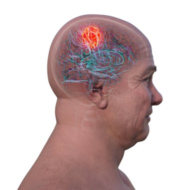 3D illustration of a brain tumor, highlighting its location and structure. Depicts common types such as glioblastoma, meningioma, and astrocytoma. clipart