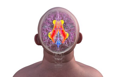 3D illustration showing enlarged lateral ventricles of the brain (hydrocephalus, orange). clipart