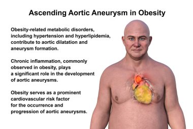 Orta yaşlı, şeffaf derisi olan, obez bir kalbi ve yükselen bir aort anevrizmasını gözler önüne seren, kardiyovasküler sağlık risklerini vurgulayan beyaz bir adamın 3 boyutlu çizimi..