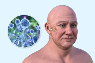 3D illustration of a man with transparent skin showing fungal-associated otitis media, featuring a close-up view of Mucor fungi. clipart