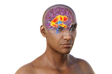 3D illustration showing enlarged lateral ventricles of the brain (hydrocephalus, orange). clipart