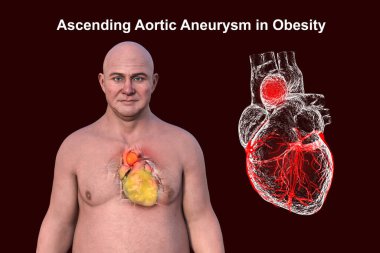 Orta yaşlı, şeffaf derisi olan, obez bir kalbi ve yükselen bir aort anevrizmasını gözler önüne seren, kardiyovasküler sağlık risklerini vurgulayan beyaz bir adamın 3 boyutlu çizimi..