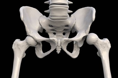 Hip dysplasia (dislocation type), 3D illustration showing misalignment of the femoral head and hip socket, highlighting skeletal anatomy and joint abnormality. clipart