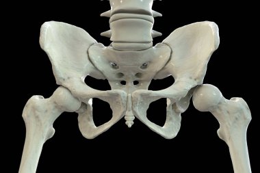 Kalça displazisi (çıkık tipi), uyluk başı ve kalça soketinin yanlış hizalandığını gösteren 3 boyutlu illüstrasyon, iskelet anatomisini ve eklem anormalliğini vurguluyor.