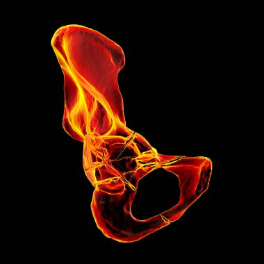 Asetabulum kırığı olan pelvik kemikler uyluk kemiğinin leğen kemiğiyle birleştiği yer olan kalça çukurunda kırık, üç boyutlu illüstrasyon. Çoğunlukla araba kazaları ya da düşme gibi yüksek çarpışma travmalarından kaynaklanır..