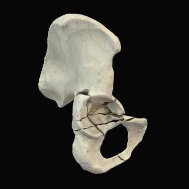 Pelvic bones with acetabulum fracture, a break in the hip socket where the femoral head meets the pelvis, 3D illustration. Often caused by high-impact trauma like car accidents or falls. clipart