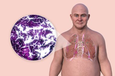 A man with silicosis-affected lungs. 3D illustration and light micrograph showing silicotic nodules and fibrosis, highlighting respiratory health issues from silica exposure. clipart