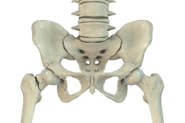 Transcervical femur kırığı, uyluk kemiğinde, kalça ekleminin yanında bir kırık olduğunu gösteren 3 boyutlu çizimler..