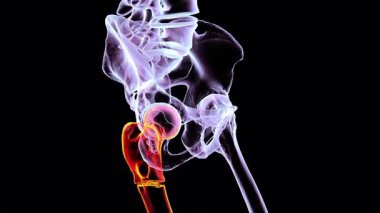 Sağ uyluk kemiğinde subtrochanterik kırık olan leğen kemiğinin 3 boyutlu animasyonu, renkli X-ray şeklinde 360 derece dönerek, sağ uyluk kemiği turuncu ve diğer kemikler mor renkte.