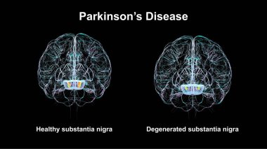 Sağlıklı insan beyninde subtantia nigra (solda) ve Parkinson hastalığında dejenere olmuş nigra (sağda), 3 boyutlu illüstrasyon