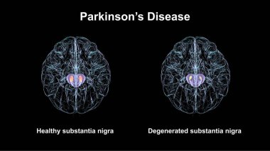 Sağlıklı insan beyninde subtantia nigra (solda) ve Parkinson hastalığında dejenere olmuş nigra (sağda), 3 boyutlu illüstrasyon