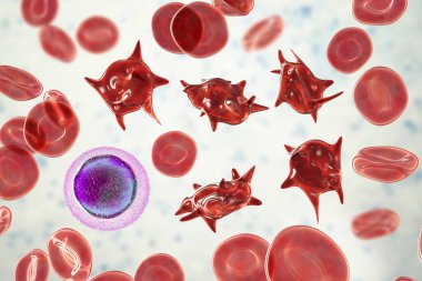 Acanthocytes, abnormal red blood cells with thorn-like projections, 3D illustration. They appear in severe liver disease, vitamin E defficiency, splenectomy, malabsorption, hypothyroidism clipart