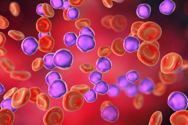 Akut lenfoblastik lösemi, kemik iliği testi, 3 boyutlu illüstrasyon.