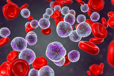 Akut lenfoblastik lösemi, kemik iliği testi, 3 boyutlu illüstrasyon.