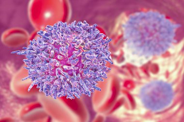 Kıllı hücre lösemisi, 3 boyutlu illüstrasyon. Anormal B lenfositleri birikmiş hematolojik, kronik lenfositik lösemi.