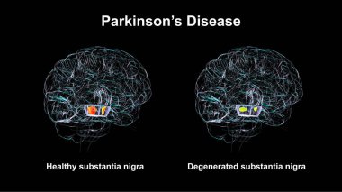 Sağlıklı insan beyninde subtantia nigra (solda) ve Parkinson hastalığında dejenere olmuş nigra (sağda), 3 boyutlu illüstrasyon