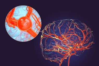Beynin orta serebral arterindeki üç boyutlu anevrizma, vasküler patoloji ve felç riskini vurguluyor..