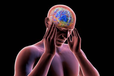 Baş ağrısı çeken bir adam, 3 boyutlu illüstrasyon.