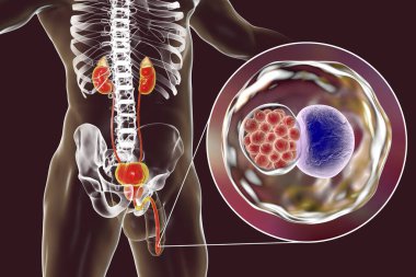İnsanda klamidyoz enfeksiyonu, 3 boyutlu illüstrasyon Chlamydia trachomatis bakterisinin üretral epitel hücreleri enfekte ettiğini gösteriyor.