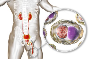 İnsanda klamidyoz enfeksiyonu, 3 boyutlu illüstrasyon Chlamydia trachomatis bakterisinin üretral epitel hücreleri enfekte ettiğini gösteriyor.