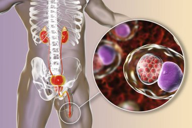 İnsanda klamidyoz enfeksiyonu, 3 boyutlu illüstrasyon Chlamydia trachomatis bakterisinin üretral epitel hücreleri enfekte ettiğini gösteriyor.
