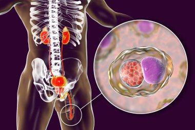 İnsanda klamidyoz enfeksiyonu, 3 boyutlu illüstrasyon Chlamydia trachomatis bakterisinin üretral epitel hücreleri enfekte ettiğini gösteriyor.