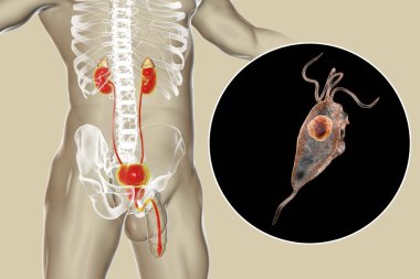 İnsanda trikomonez enfeksiyonu, erkekte anatomi üreme sistemi ve üretrit iltihabına yol açan Trikomonas vajinalis protozoanın yakın çekim görüntülerini gösteren 3 boyutlu illüstrasyon.