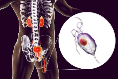 İnsanda trikomonez enfeksiyonu, üretrit iltihabına neden olan trikomonik vajinaya yakın çekim ve üretrit erkek anatomisini gösteren 3 boyutlu illüstrasyon.
