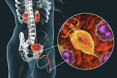 İnsanda trikomonez enfeksiyonu, üretrit iltihabına neden olan trikomonik vajinaya yakın çekim ve üretrit erkek anatomisini gösteren 3 boyutlu illüstrasyon.