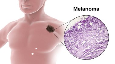 Erkek vücudunda melanoma, pigment içerikli hücrelerden oluşan bir kanser, 3 boyutlu illüstrasyon.