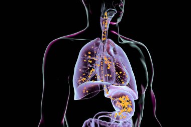 Aspirasyon pnömonisi, mide asidi ve gıda parçacıklarının soluk borusuna ve akciğerlere girerek iltihaplanmaya neden olduğunu gösteren kavramsal 3D çizim..