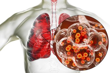 İnsan ciğerlerindeki SARS-CoV-2 virüsleri COVID-19 'a neden oluyor. Roman Coronavirus enfeksiyonu, 3 boyutlu illüstrasyon