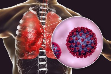 İnsan ciğerlerindeki SARS-CoV-2 virüsleri COVID-19 'a neden oluyor. Roman Coronavirus enfeksiyonu, 3 boyutlu illüstrasyon
