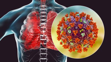 İnsan ciğerlerindeki SARS-CoV-2 virüsleri COVID-19 'a neden oluyor. Roman Coronavirus enfeksiyonu, 3 boyutlu illüstrasyon